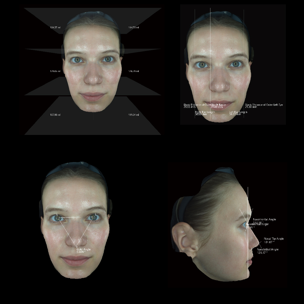 Filler Volume Calculation & Accurate Facial Morphology Analysis