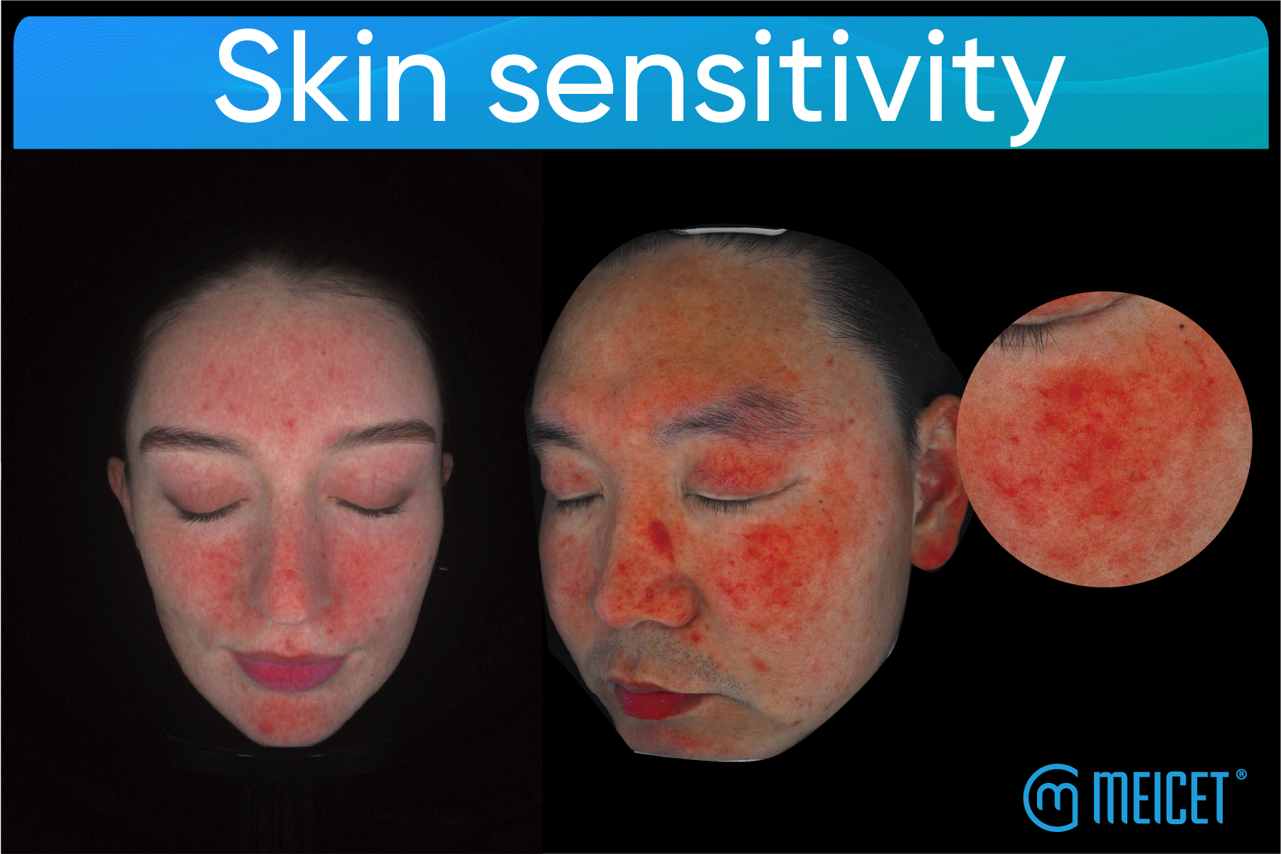 ત્વચાની સંવેદનશીલતાને સમજવી: કારણો, પ્રકારો, સારવારની વ્યૂહરચના અને ત્વચા વિશ્લેષણ ઉપકરણોની ભૂમિકા