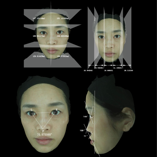 Filler Volume Calculation & Accurate Facial Morphology Analysis